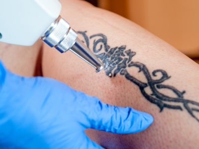 Laserowe usuwanie tatuażu. Jak przygotować się do zabiegu? Ile to kosztuje?