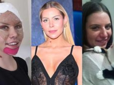 Julia von Stein zafundowała sobie lifting twarzy. Pamiętacie, jak KIEDYŚ wyglądała?