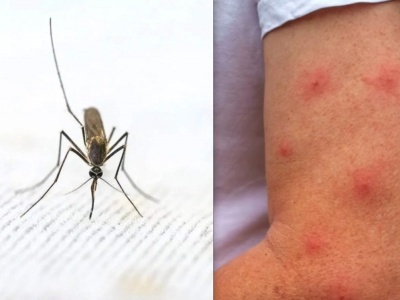 Potrzyj obrzęk skórką owocu. Cudowne antidotum na ukąszenie komara