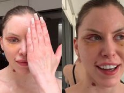 Julia von Stein prezentuje odmienione oblicze 8 DNI PO OPERACJI: 
