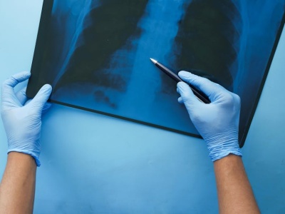 Radioterapia może przełamać oporność na immunoterapię w raku płuca