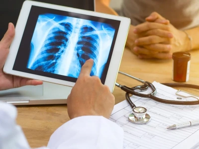 Rak płuca zabija najczęściej. Oto nietypowe objawy, które mogą opóźnić diagnozę i leczenie