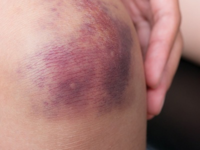 Nie znikały jej siniaki, trafiła do szpitala. Diagnoza była szokiem
