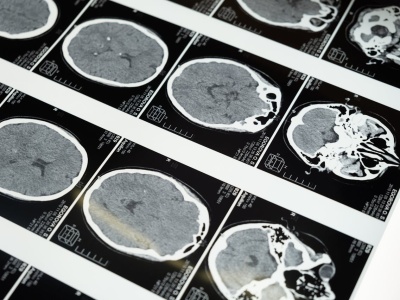 MMI i Jacobs Institute: pionierska mikrochirurgia mózgu z użyciem robota
