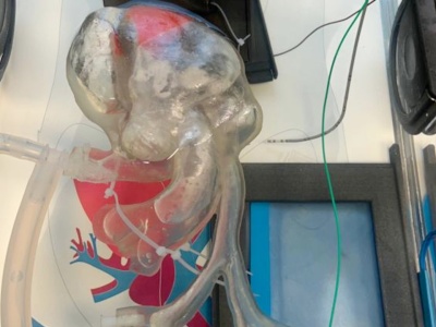 Medinice zrekrutowało wymaganą liczbę uczestników badania klinicznego CoolCryo