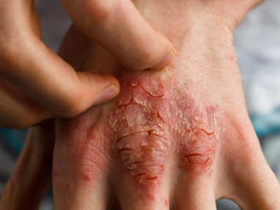 Ukryte obciążenia związane z egzemą: Jak stan zapalny, dieta i zdrowie psychiczne wpływają na atopowe zapalenie skóry