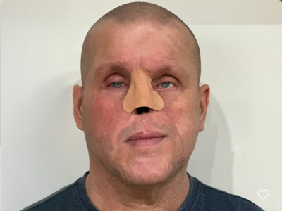 Mieszkaniec Białołęki potrzebuje pieniędzy na rekonstrukcję amputowanego nosa. 