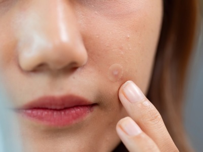 Zanim nakleisz na pryszcza, sprawdź. Nie wszystkie zadziałają idealnie