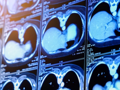 Nowa broń przeciw alkoholowej chorobie wątroby. Rewolucyjne odkrycie naukowców