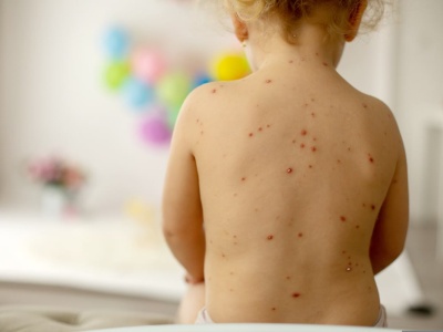 Lekarka wymienia trzy rzeczy, których nie wolno robić przy ospie. Kiedyś rodzice masowo popełniali jeden błąd