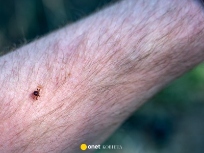 47-latek zmarł wskutek alergii na czerwone mięso. Wywołało ją ukąszenie kleszcza