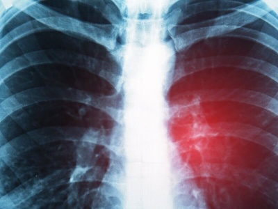 Rak drobnokomórkowy płuca to najbardziej agresywny nowotwór. Immunoterapia to szansa dla chorych