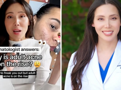 Coraz więcej dorosłych zmaga się z trądzikiem. Dermatolożka podpowiada, jak z nim walczyć