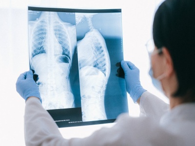 Sztuczna inteligencja w diagnostyce gruźlicy: przełomowe technologie zaprezentowane w Kopenhadze