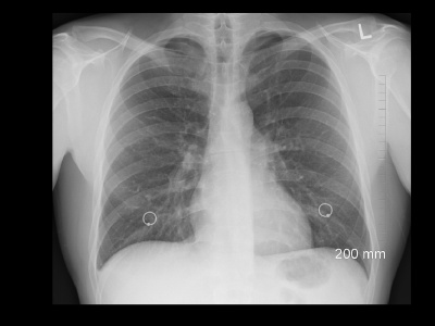 Idiopatyczne włóknienie płuc