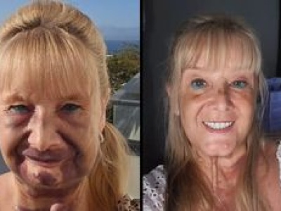 Jej zęby były w ruinie. Wyrwała je i wstawiła tureckie implanty. Pokazała EFEKT PRZED I PO (ZDJĘCIA)