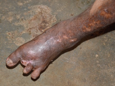 Ubogacenie imigrantami w praktyce: do Europy wrócił trąd