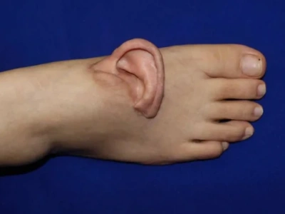 Chińscy chirurdzy dokonali przełomu: oderwane ucho zostało tymczasowo przeszczepione do stopy