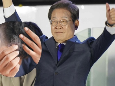 Korea Płd. dyskutuje, czy leczenie łysienia powinno być częścią ochrony zdrowia