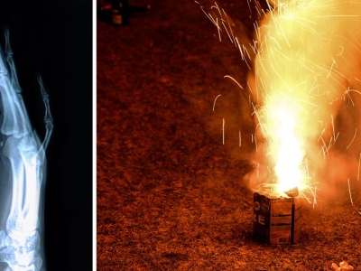 Koszmar. Petarda wybuchła w dłoni dziecka. Konieczna była amputacja