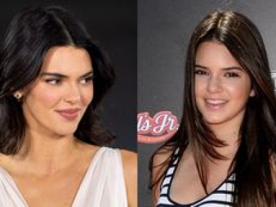 Kendall Jenner twierdzi, że nie miała żadnej operacji plastycznej i zapewnia, że LEK NA TRĄDZIK ZMNIEJSZYŁ JEJ NOS. Wierzycie?