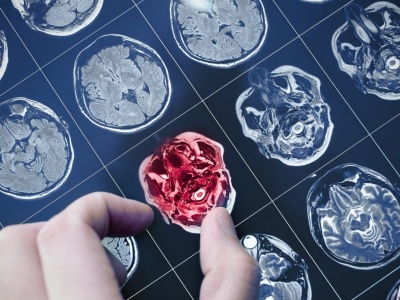 Rewolucyjny test na Alzheimera! Prosto z palca i bez wychodzenia z domu?