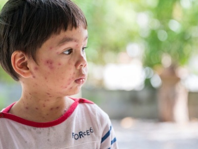 Ospa wietrzna trafia do kalendarza szczepień na powszechnych zasadach