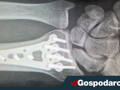 Sezon złamań trwa w najlepsze