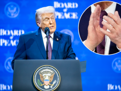 Siniak na dłoni Trumpa przykuł uwagę mediów. Biały Dom wyjaśnia