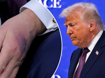 Niepokojący wygląd dłoni Trumpa. Biały Dom reaguje, jest oświadczenie