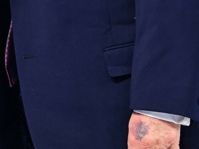 ​Biały Dom wydał oświadczenie ws. siniaka na dłoni Trumpa