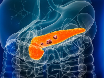 Odkryli, jak zmusić raka trzustki do kapitulacji. Rewolucyjna terapia