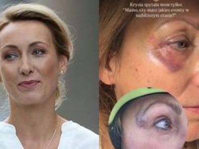 Anna Kalczyńska miała wypadek na nartach. Pokazała zdjęcie siniaków: 
