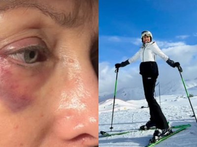 Niepokojące zdjęcia na profilu Anny Kalczyńskiej. Miała wypadek na nartach