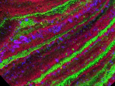 W kamieniach nerkowych odkryto całe warstwy tworzone przez bakterie