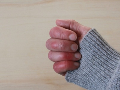 Zima atakuje skórę. Czas na odmrożenia i oparzenia