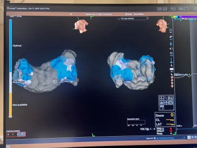 Nowa era leczenia arytmii w Bielsku-Białej: pierwsze zabiegi systemem Volt