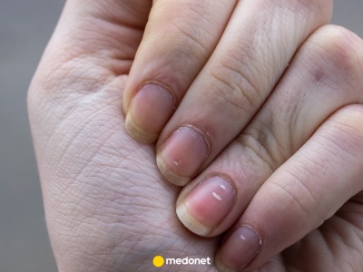 Dlaczego mam białe kreski na paznokciach? Stąd się biorą