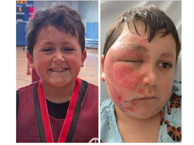 Niebezpieczny trend z TikToka. 9-latek ciężko poparzony po włożeniu zabawki do mikrofalówki