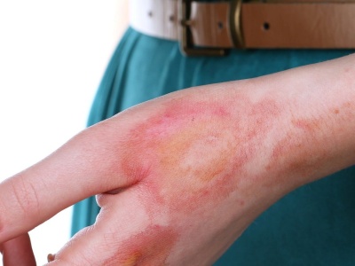 Ewolucyjna rola ognia. Oparzenia mogły ukształtować naszą odporność