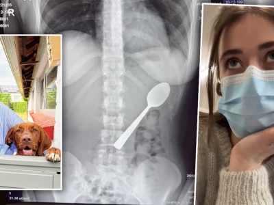 Przez przypadek połknęła łyżeczkę. Lekarze nie mogli uwierzyć w te zdjęcia