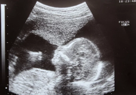 Co na to feministki? Wlk. Brytania: Selektywne aborcje dziewczynek