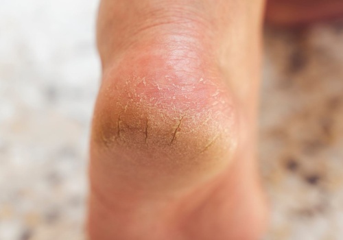 Zapomniana perełka z apteki. Stopy będą gładziutkie. Zapłacisz 15 zł