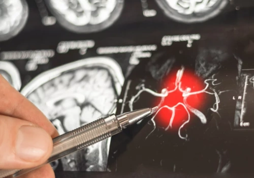 Będzie zmiana w leczeniu alzheimera? Jest już wniosek