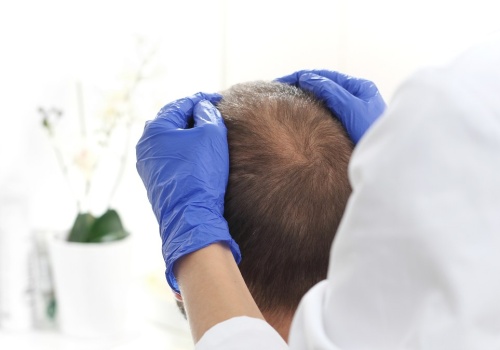 Tradycyjna medycyna chińska w walce z łysieniem androgenowym