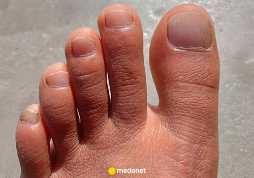 20 proc. ludzi ma palec grecki u stopy. Co to oznacza dla zdrowia? Mogą być problemy