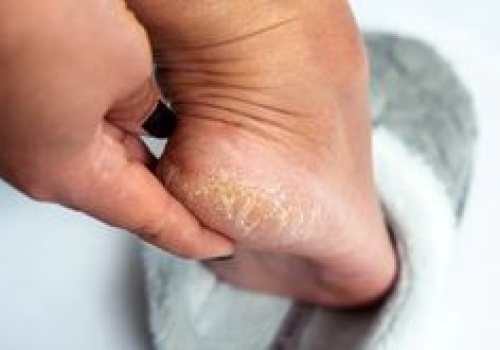 Kosztuje 15 zł. Hit z apteki na suche pięty