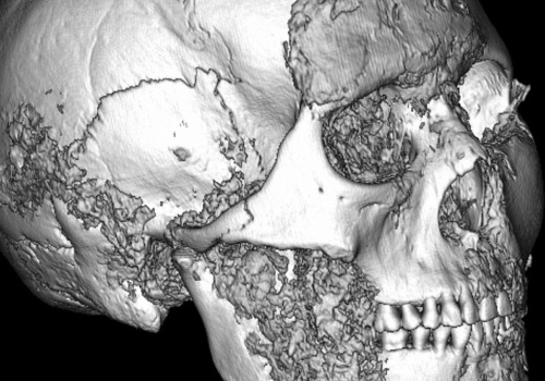 Starożytni chirurdzy z Ałtaju. W dalekiej Azji wykonywano skomplikowane operacje