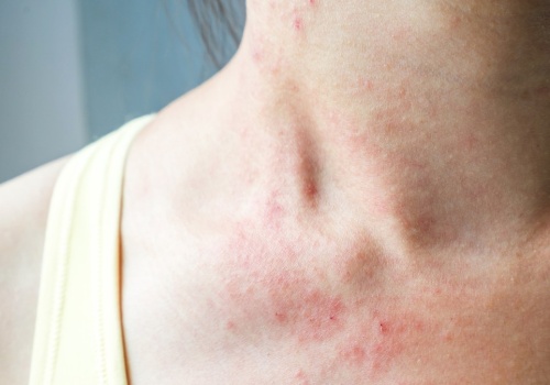 Skóra swędzi i piecze? Winny może być przedmiot, którego używasz codziennie