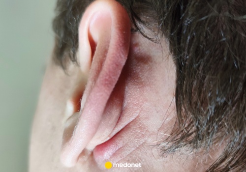 Masz ten znak na uchu? Może ostrzegać przed zawałem serca